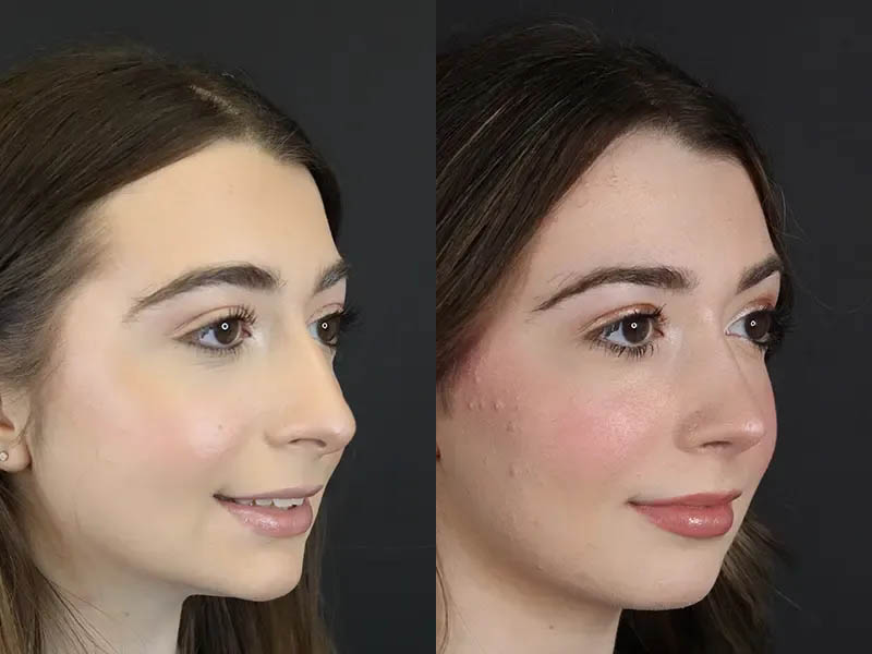 Rhinoplasty case #9650