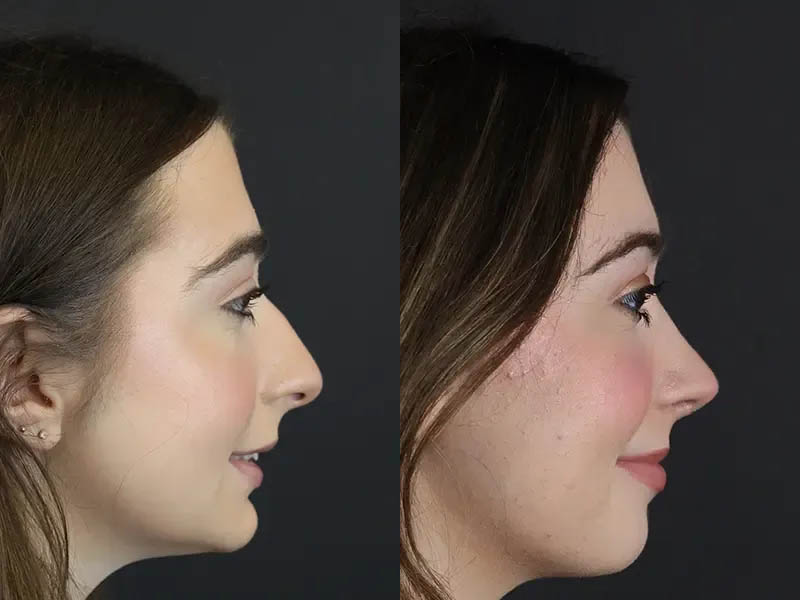 Rhinoplasty case #9650