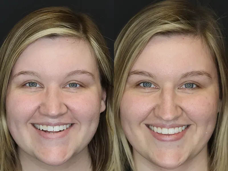 Rhinoplasty case #9690