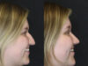 Rhinoplasty case #9690 slider thumbnail