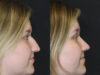 Rhinoplasty case #9690 slider thumbnail