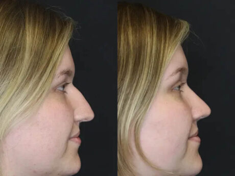 Rhinoplasty case #9690