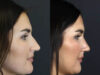 Rhinoplasty case #9707 slider thumbnail