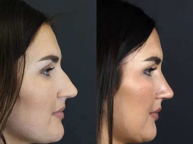 Rhinoplasty case #9707