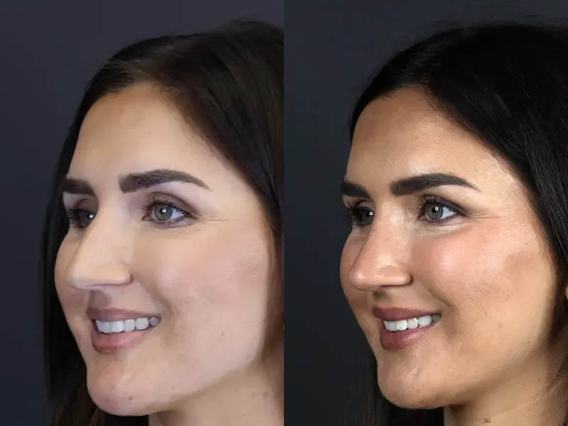 Rhinoplasty case #9707
