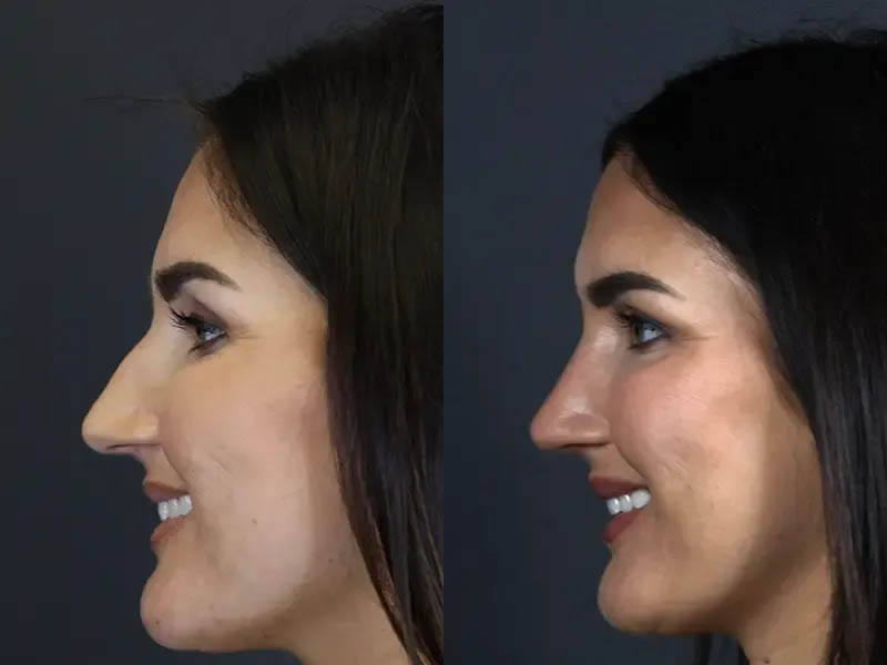 Rhinoplasty case #9707