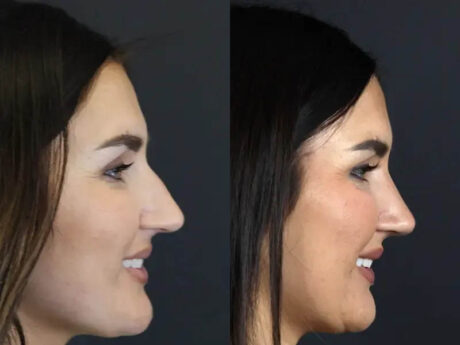 Rhinoplasty case #9707