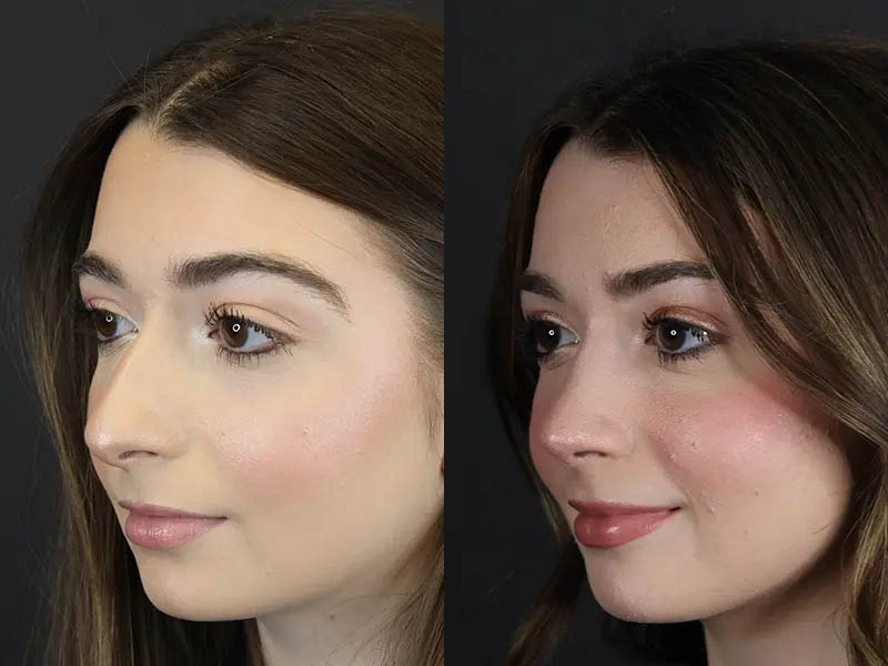 Rhinoplasty case #9650