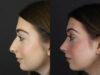 Rhinoplasty case #9650 slider thumbnail