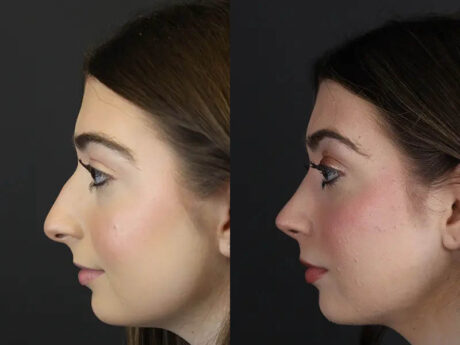 Rhinoplasty case #9650
