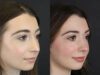 Rhinoplasty case #9650 slider thumbnail
