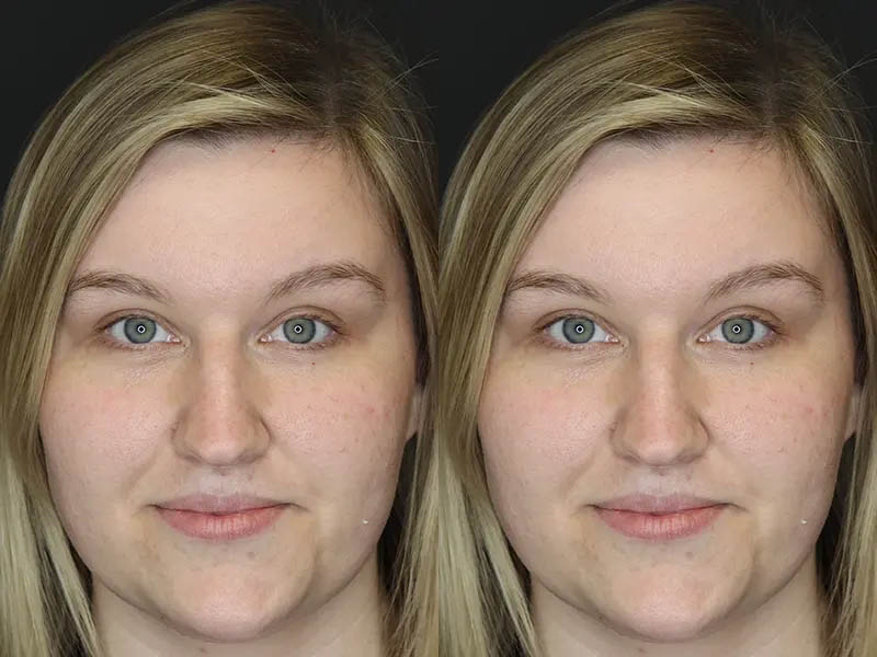 Rhinoplasty case #9690