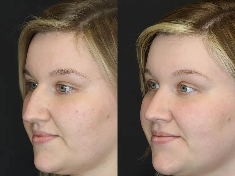 Rhinoplasty case #9690