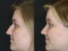 Rhinoplasty case #9690 slider thumbnail