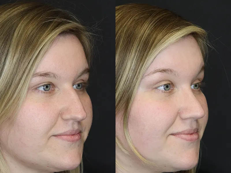 Rhinoplasty case #9690