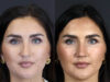 Rhinoplasty case #9707 slider thumbnail