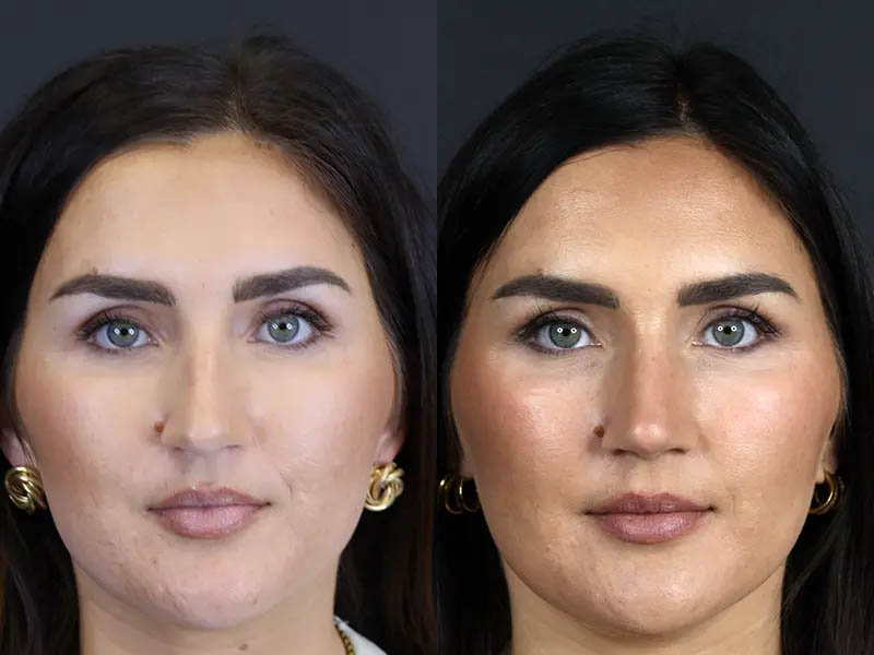 Rhinoplasty case #9707