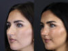 Rhinoplasty case #9707 slider thumbnail