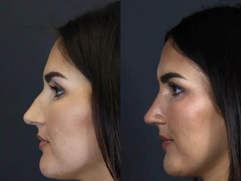 Rhinoplasty case #9707
