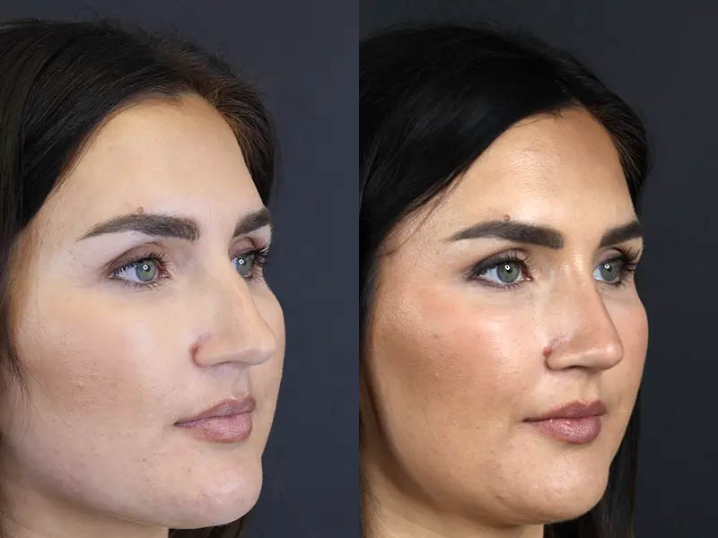 Rhinoplasty case #9707