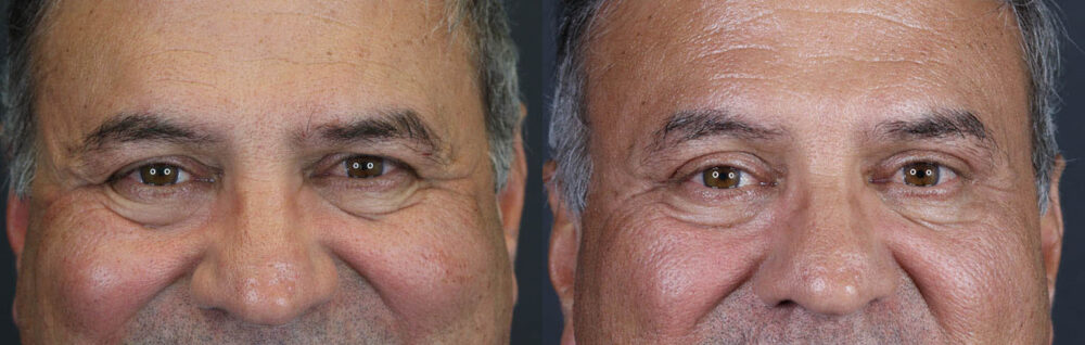 Blepharoplasty case #9598