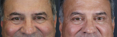 Blepharoplasty case #9598