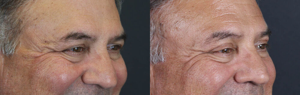 Blepharoplasty case #9598