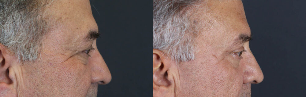 Blepharoplasty case #9598