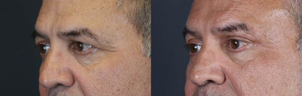 Blepharoplasty case #9598