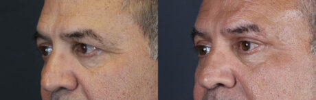 Blepharoplasty case #9598