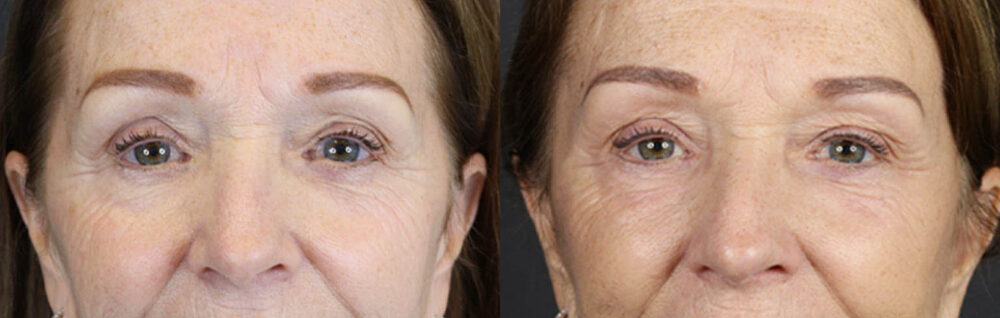 Brow Lift case #9750
