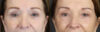 Brow Lift case #9750 slider thumbnail