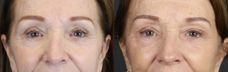 Brow Lift case #9750