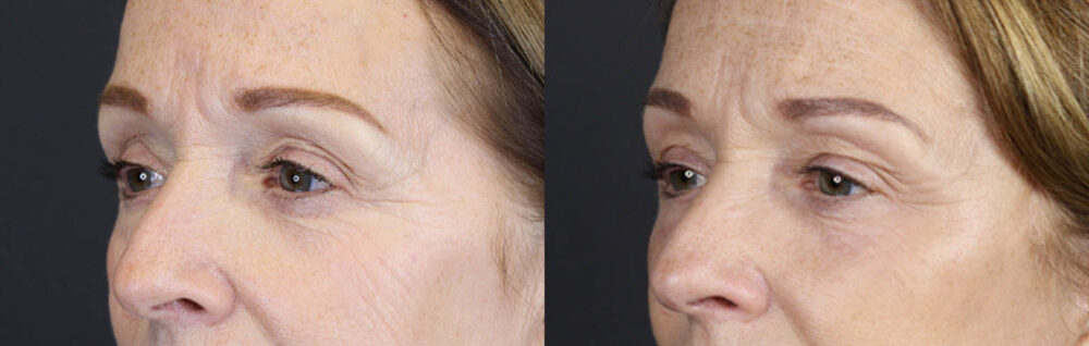 Brow Lift case #9750