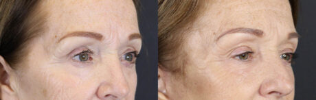 Brow Lift case #9750