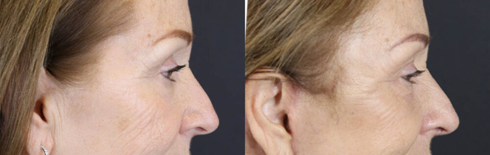 Brow Lift case #9750