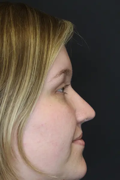 Rhinoplasty case #9690