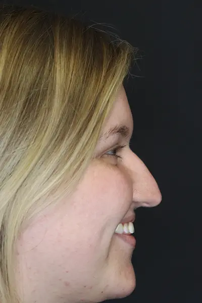 Rhinoplasty case #9690