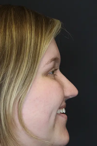 Rhinoplasty case #9690