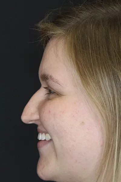Rhinoplasty case #9690