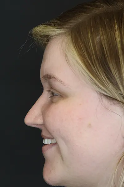 Rhinoplasty case #9690