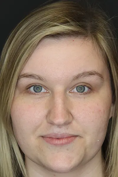 Rhinoplasty case #9690