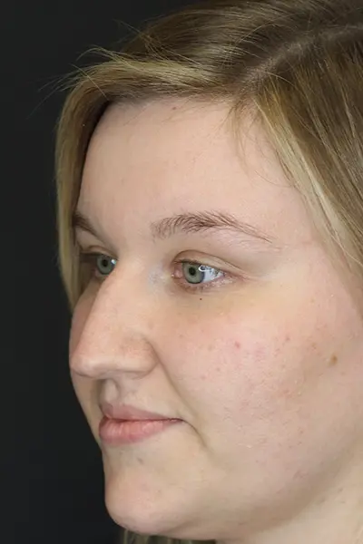 Rhinoplasty case #9690