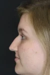 Rhinoplasty case #9690