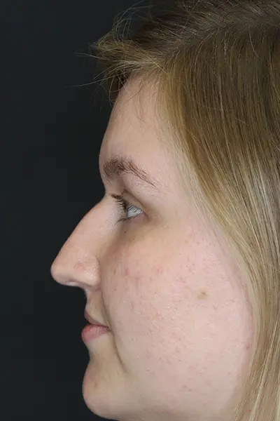 Rhinoplasty case #9690