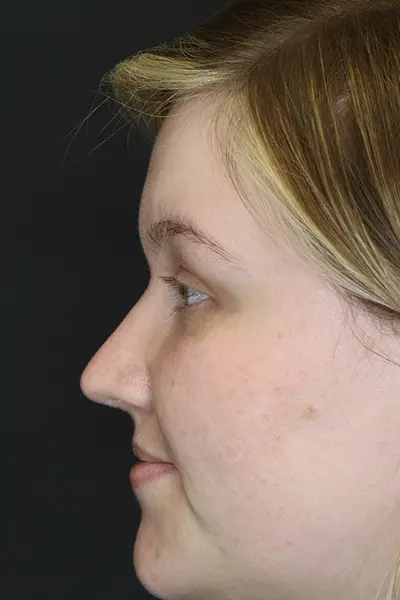 Rhinoplasty case #9690