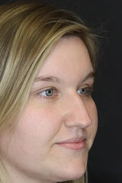 Rhinoplasty case #9690