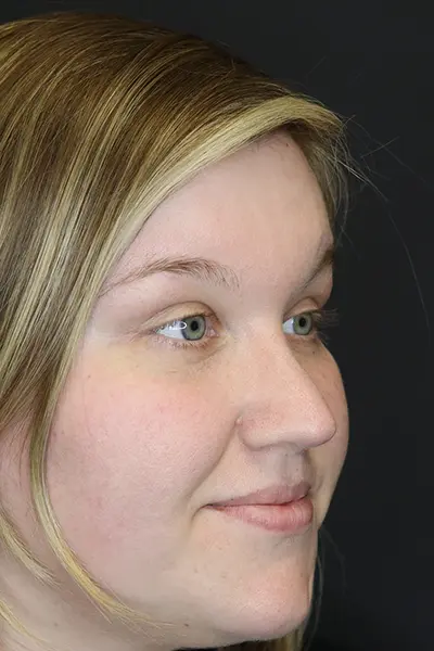 Rhinoplasty case #9690