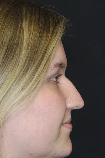 Rhinoplasty case #9690