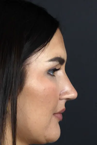 Rhinoplasty case #9707